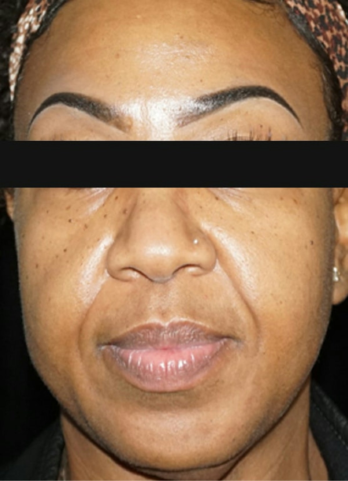 Nasolabial Folds Before & After Gallery - Patient 299409 - Image 1