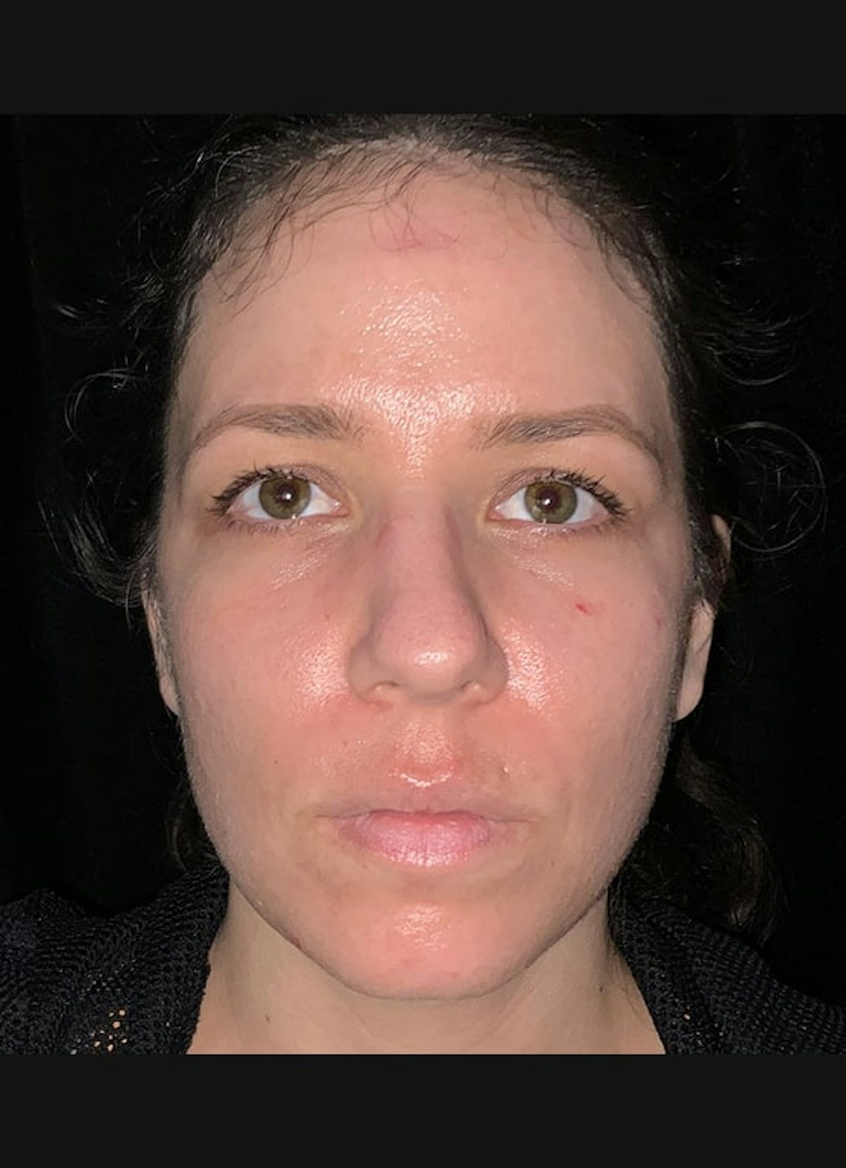Nasolabial Folds Before & After Gallery - Patient 284349 - Image 2