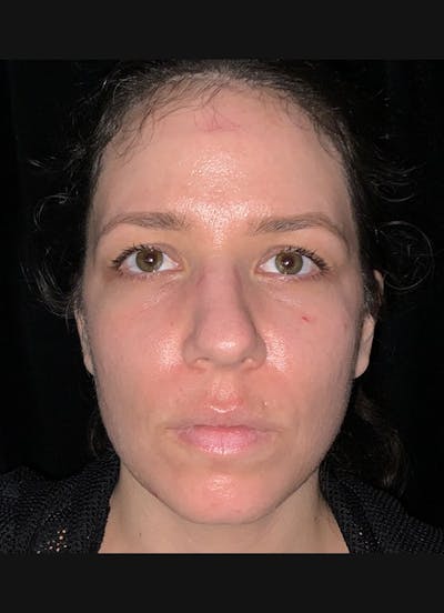 Nasolabial Folds Before & After Gallery - Patient 284349 - Image 2