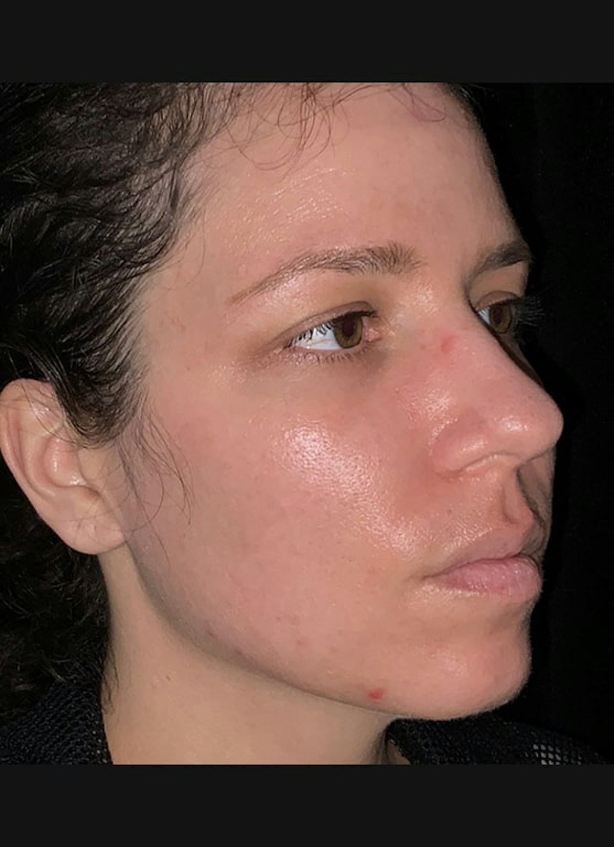 Nasolabial Folds Before & After Gallery - Patient 284349 - Image 4