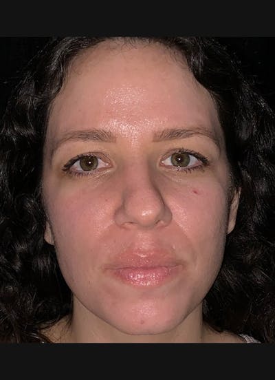 Nasolabial Folds Before & After Gallery - Patient 284349 - Image 1