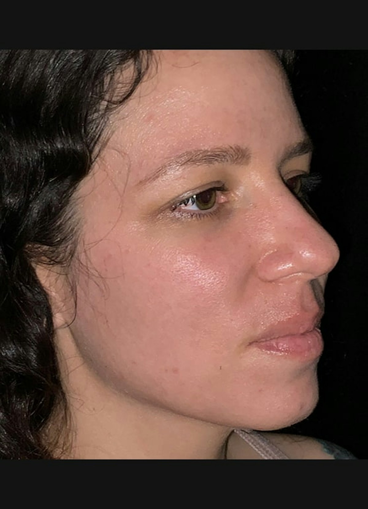Nasolabial Folds Before & After Gallery - Patient 284349 - Image 3