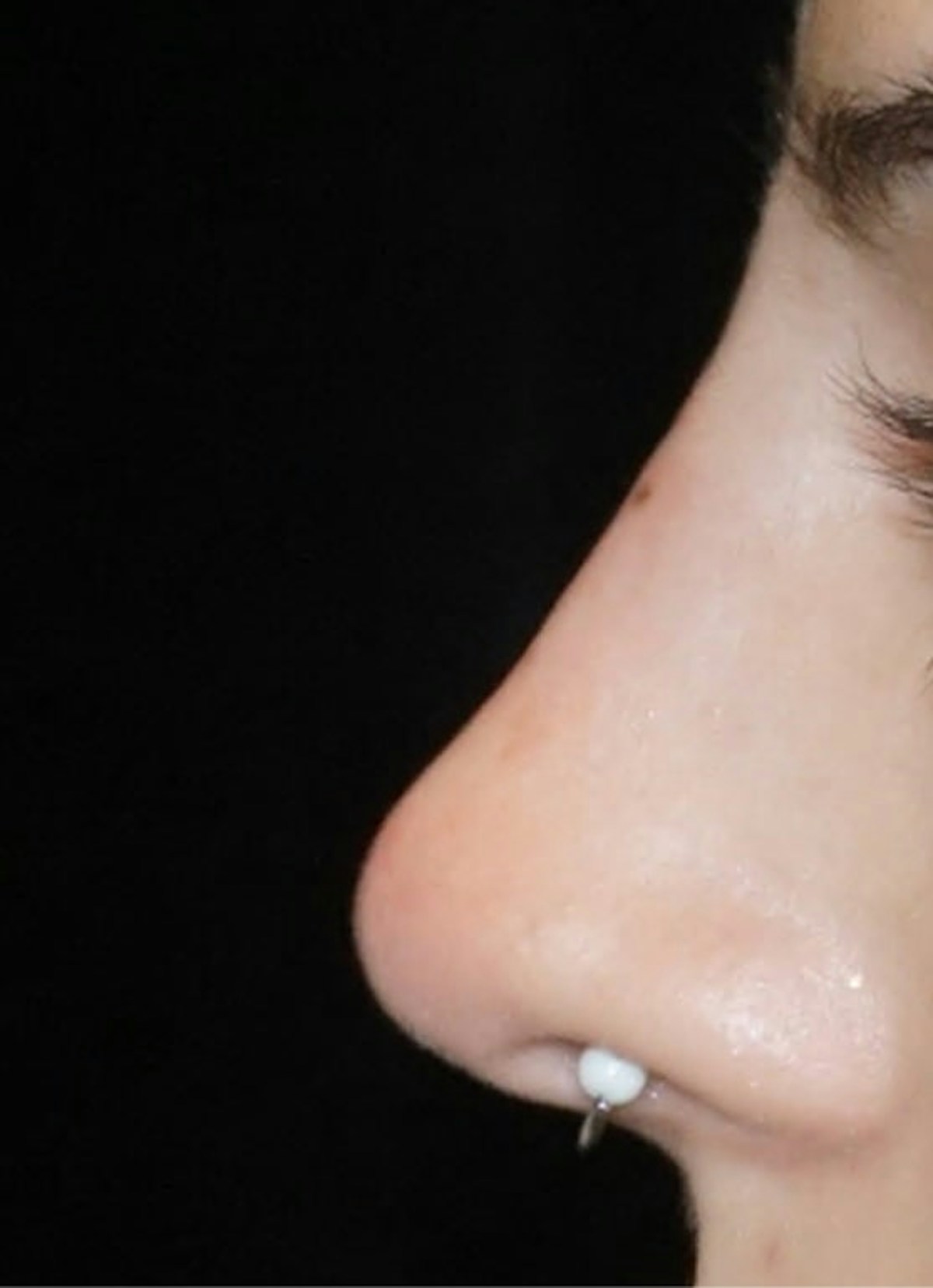 Nose Filler Before & After Gallery - Patient 389385 - Image 2