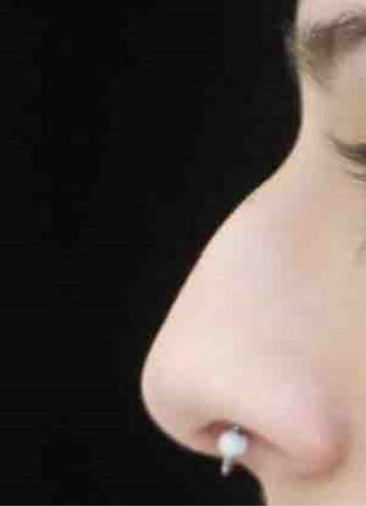 Nose Filler Before & After Gallery - Patient 389385 - Image 1