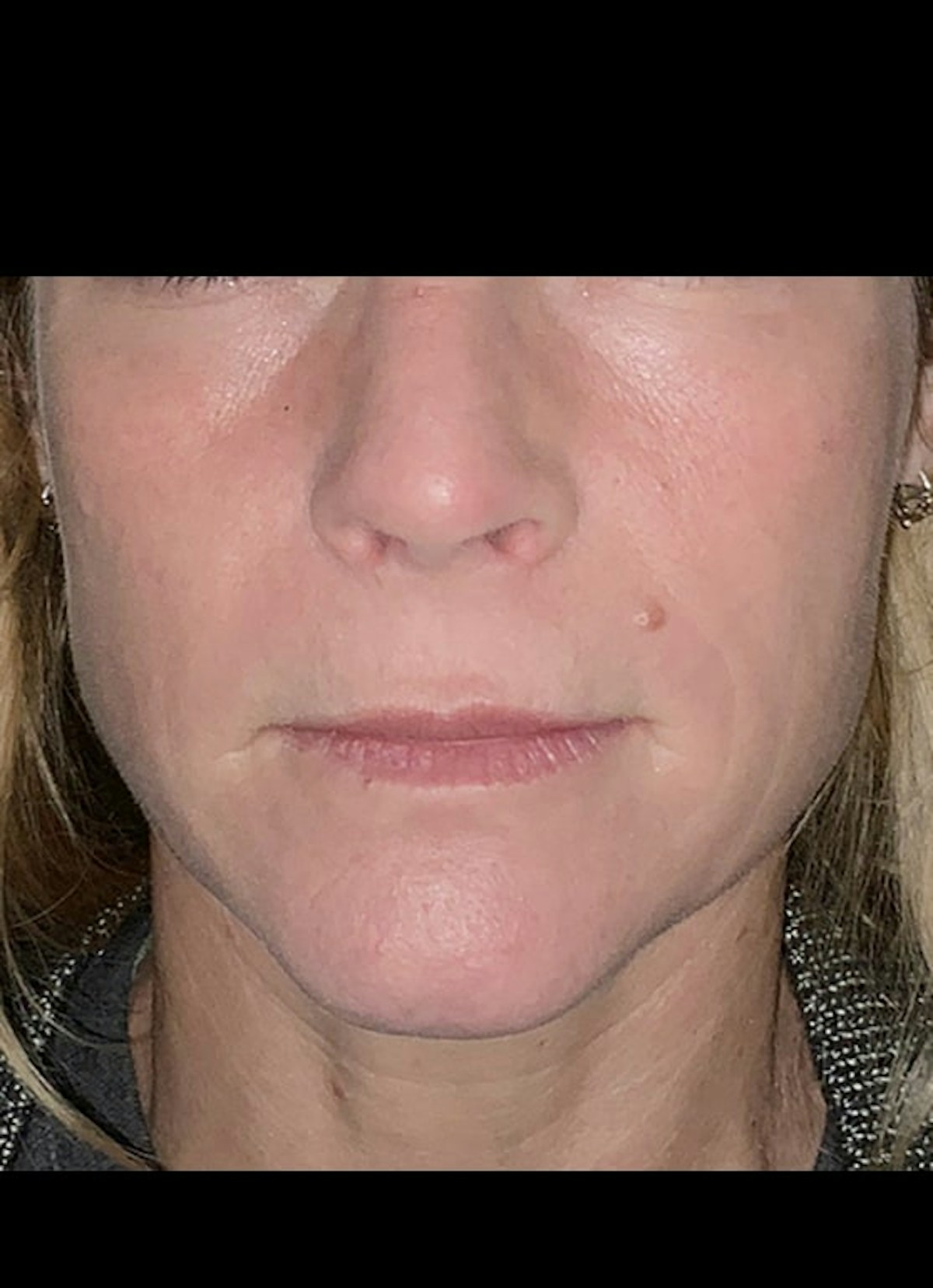 Radial Lip Lines Before & After Gallery - Patient 136606 - Image 2