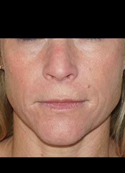 Radial Lip Lines Before & After Gallery - Patient 136606 - Image 1
