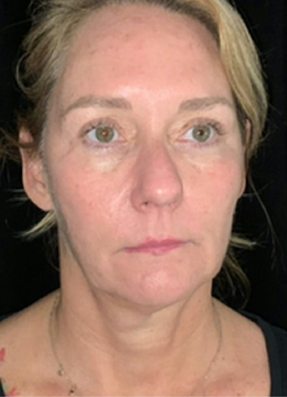 Kybella Before & After Gallery - Patient 369645 - Image 2