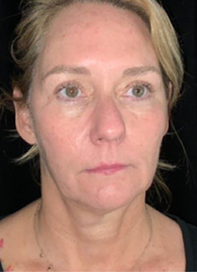 Kybella Before & After Gallery - Patient 369645 - Image 2