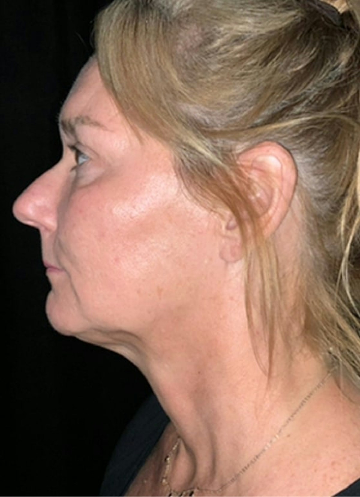 Kybella Before & After Gallery - Patient 369645 - Image 4