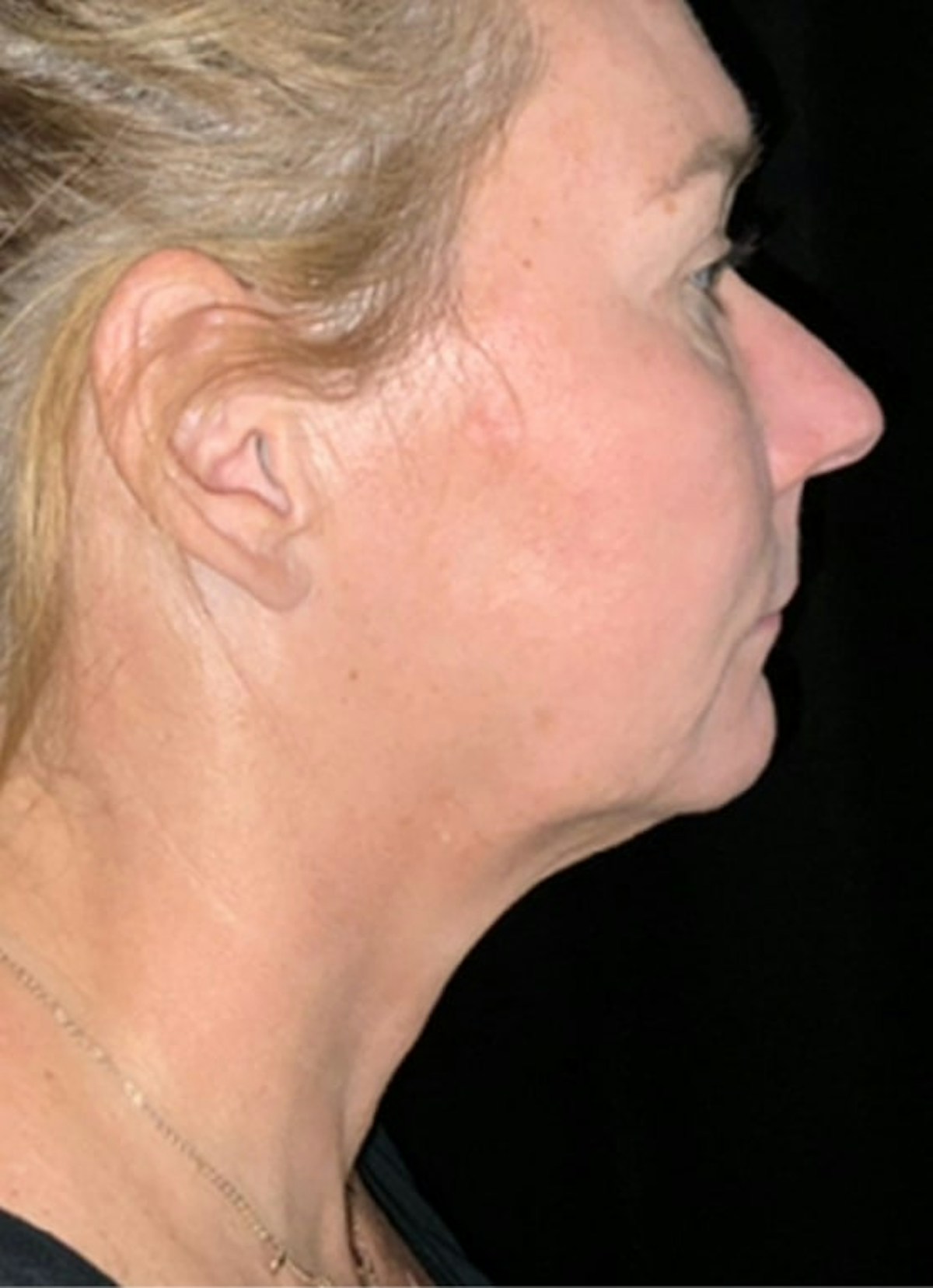 Kybella Before & After Gallery - Patient 369645 - Image 6