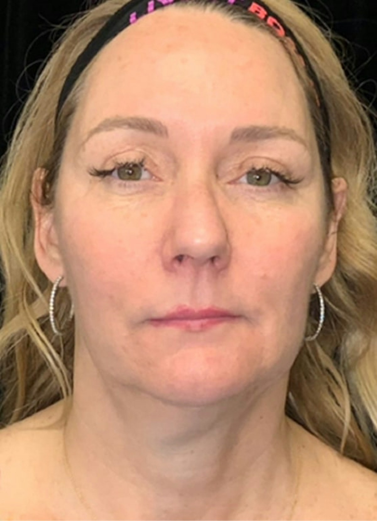Kybella Before & After Gallery - Patient 369645 - Image 1