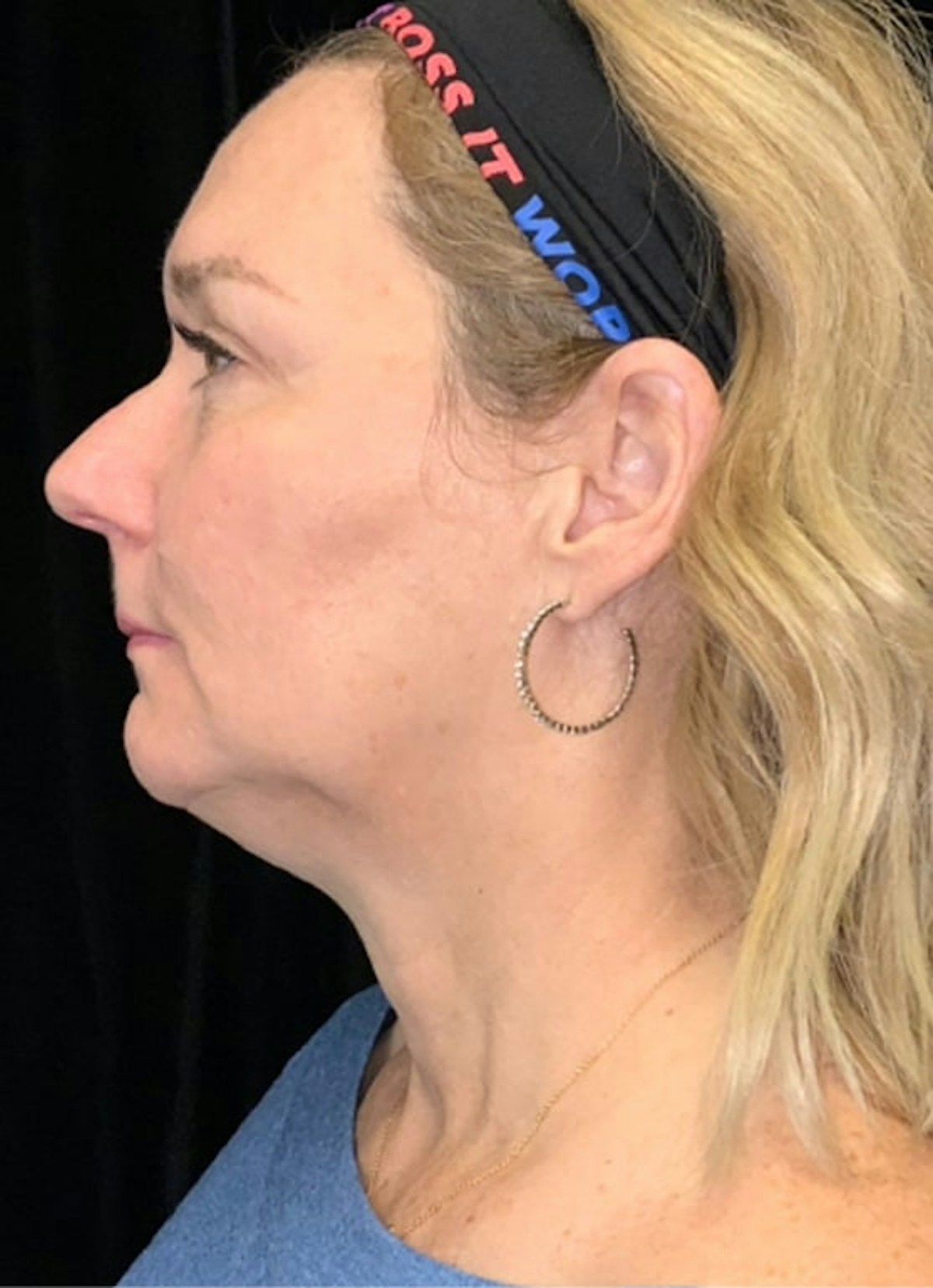 Kybella Before & After Gallery - Patient 369645 - Image 3