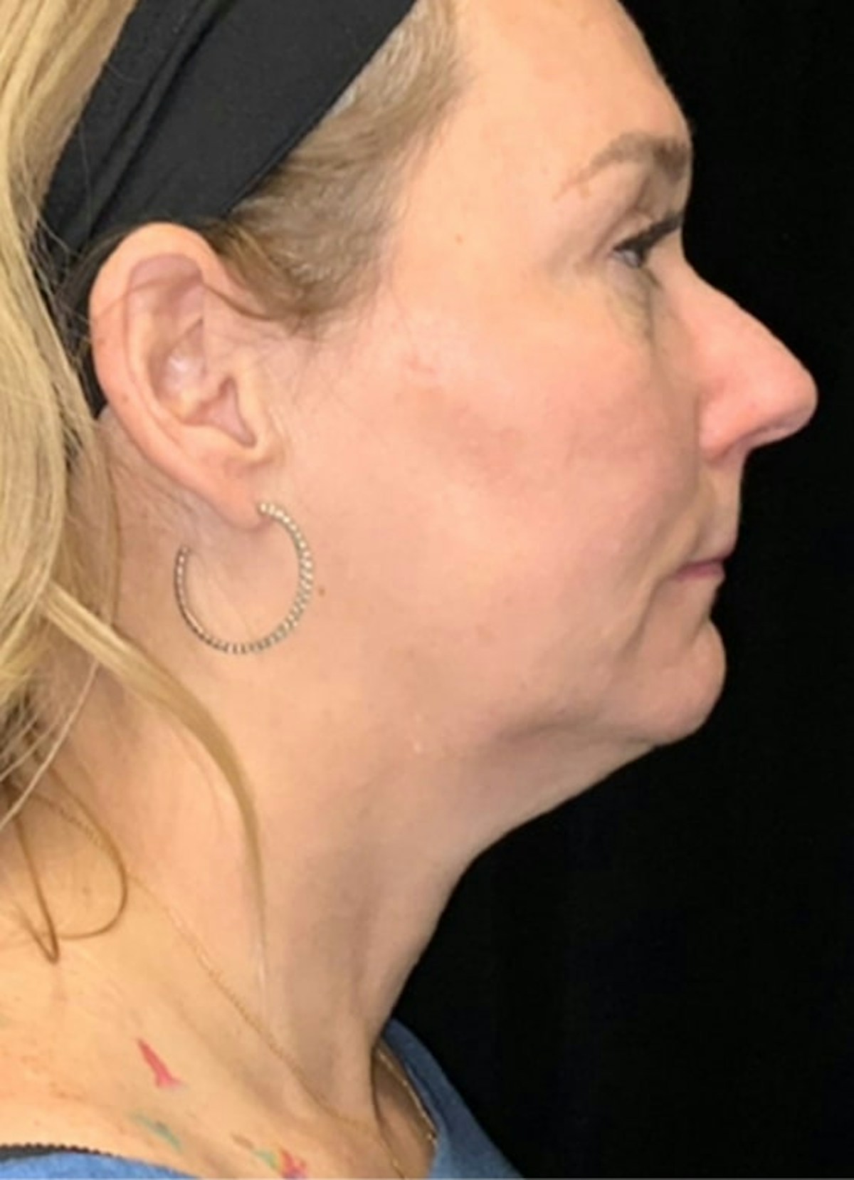 Kybella Before & After Gallery - Patient 369645 - Image 5