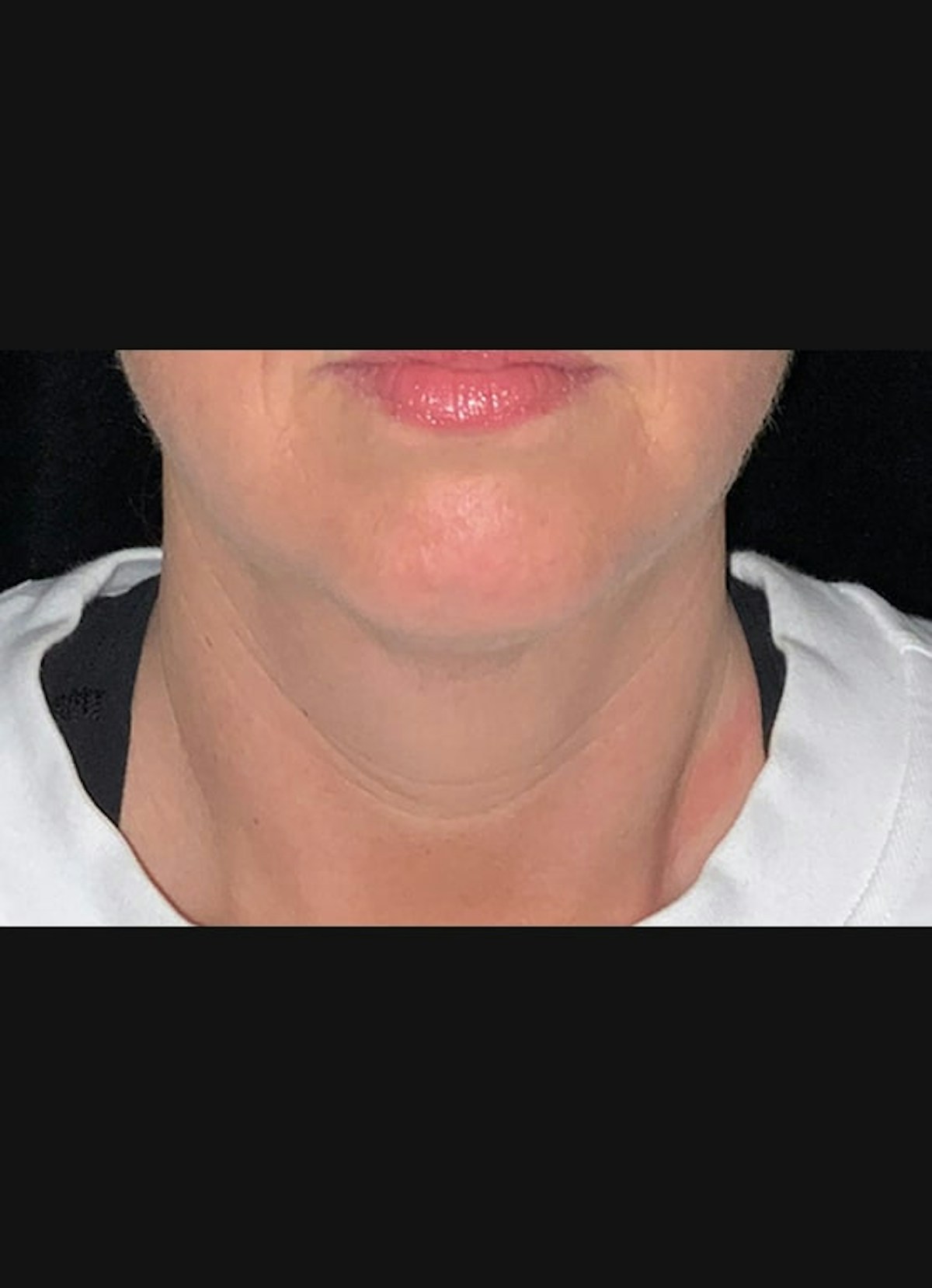 Kybella Before & After Gallery - Patient 283793 - Image 2