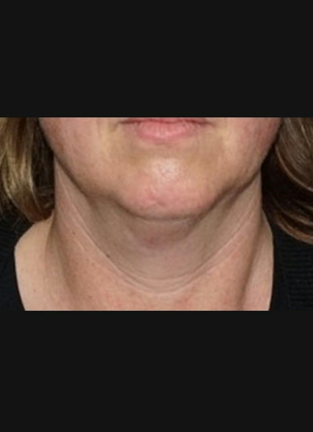 Kybella Before & After Gallery - Patient 283793 - Image 1
