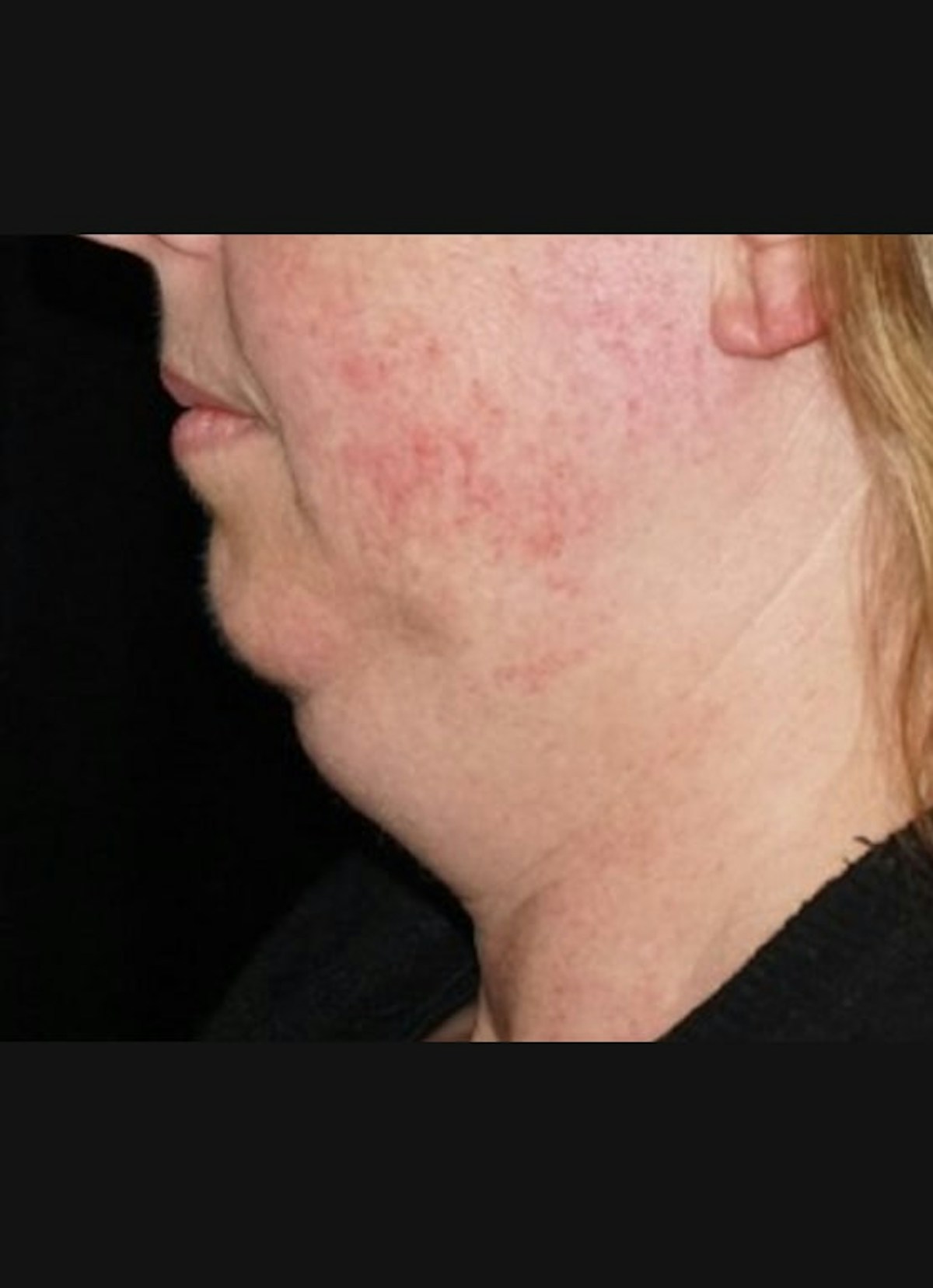 Kybella Before & After Gallery - Patient 283793 - Image 3