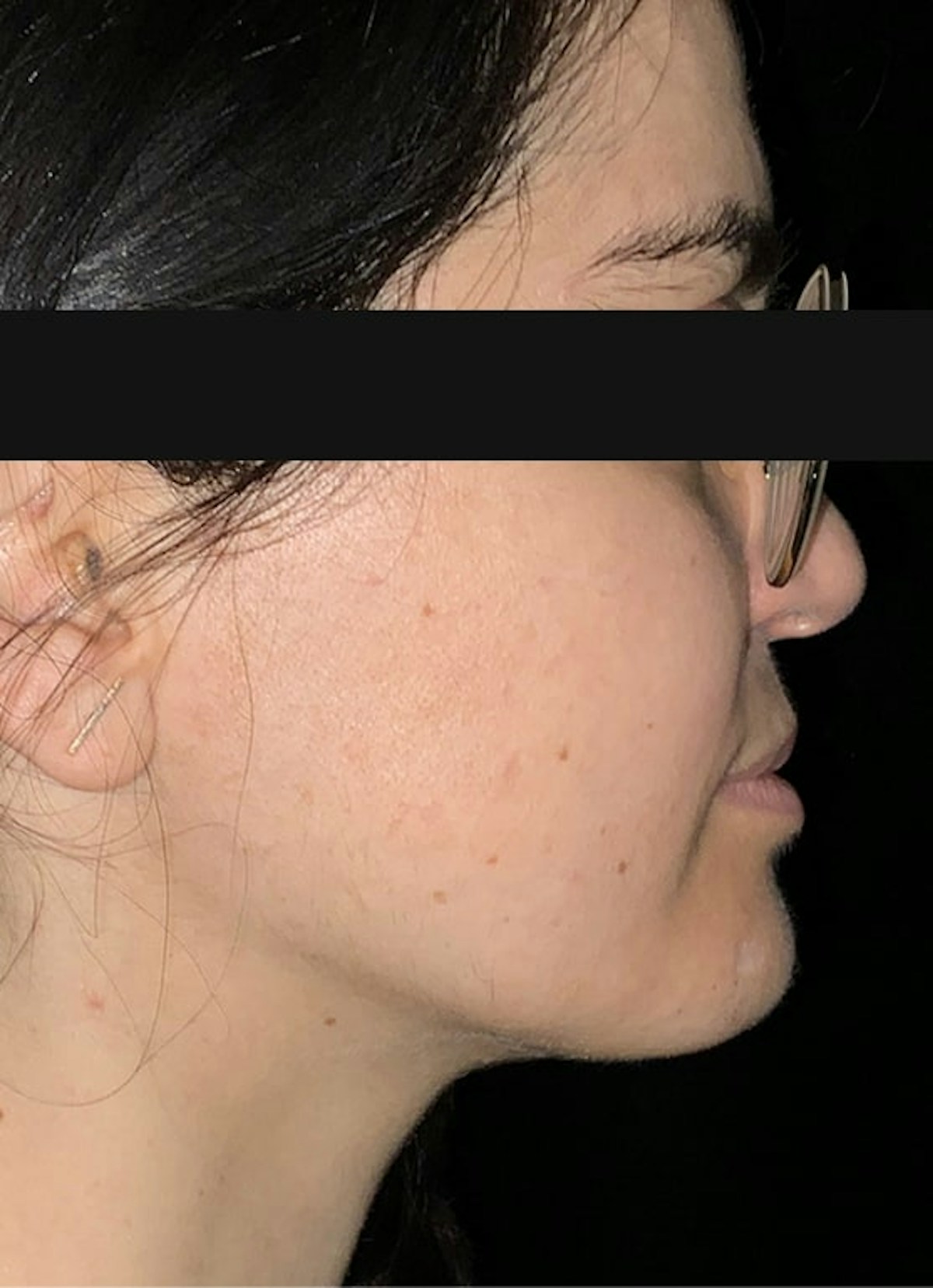 Kybella Before & After Gallery - Patient 100144 - Image 2