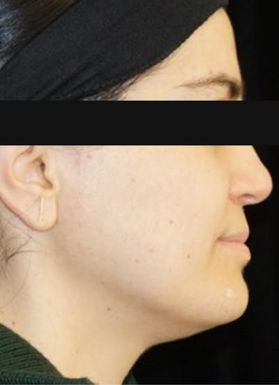 Kybella Before & After Gallery - Patient 100144 - Image 1