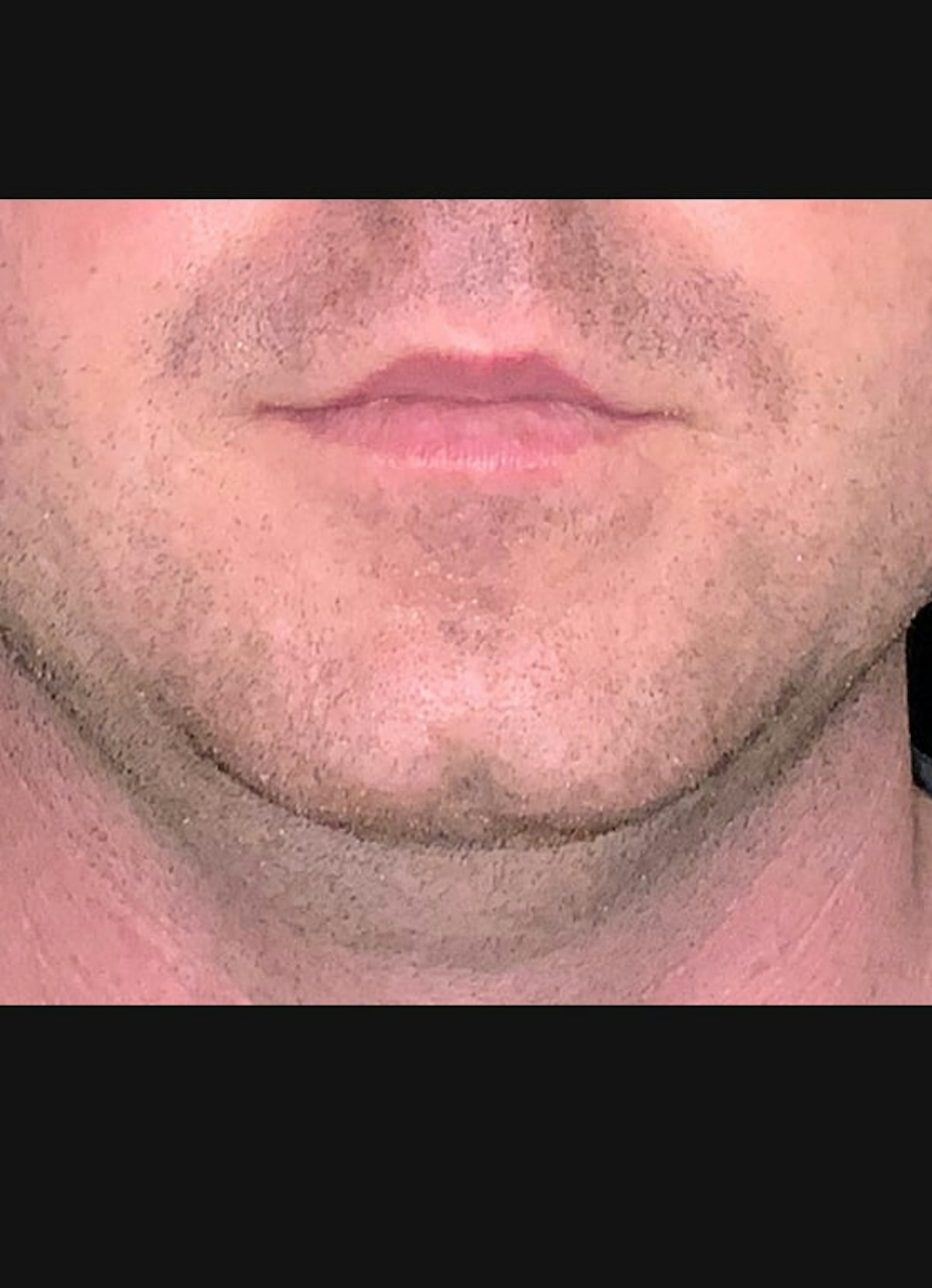 Kybella Before & After Gallery - Patient 184040 - Image 1