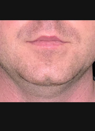 Kybella Before & After Gallery - Patient 184040 - Image 1