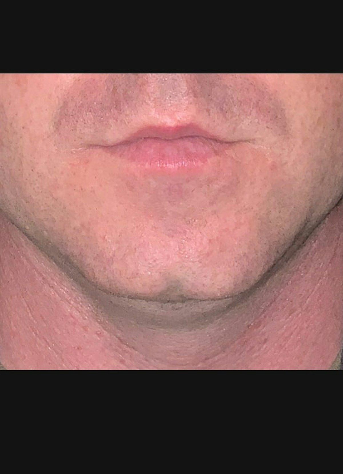 Kybella Before & After Gallery - Patient 184040 - Image 2