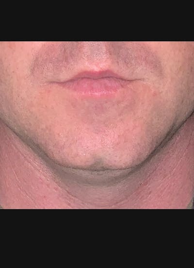 Kybella Before & After Gallery - Patient 184040 - Image 2