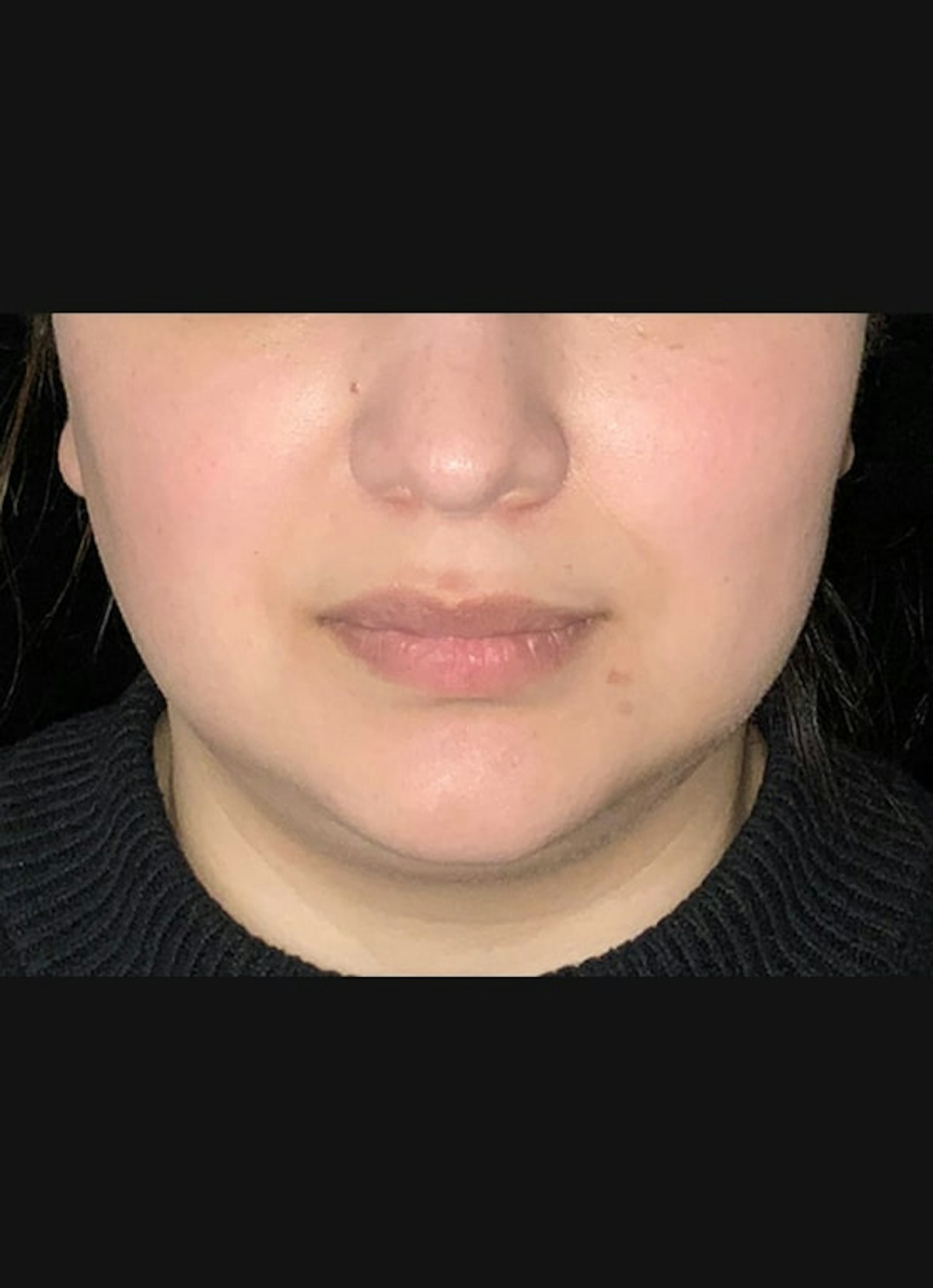 Kybella Before & After Gallery - Patient 153782 - Image 2