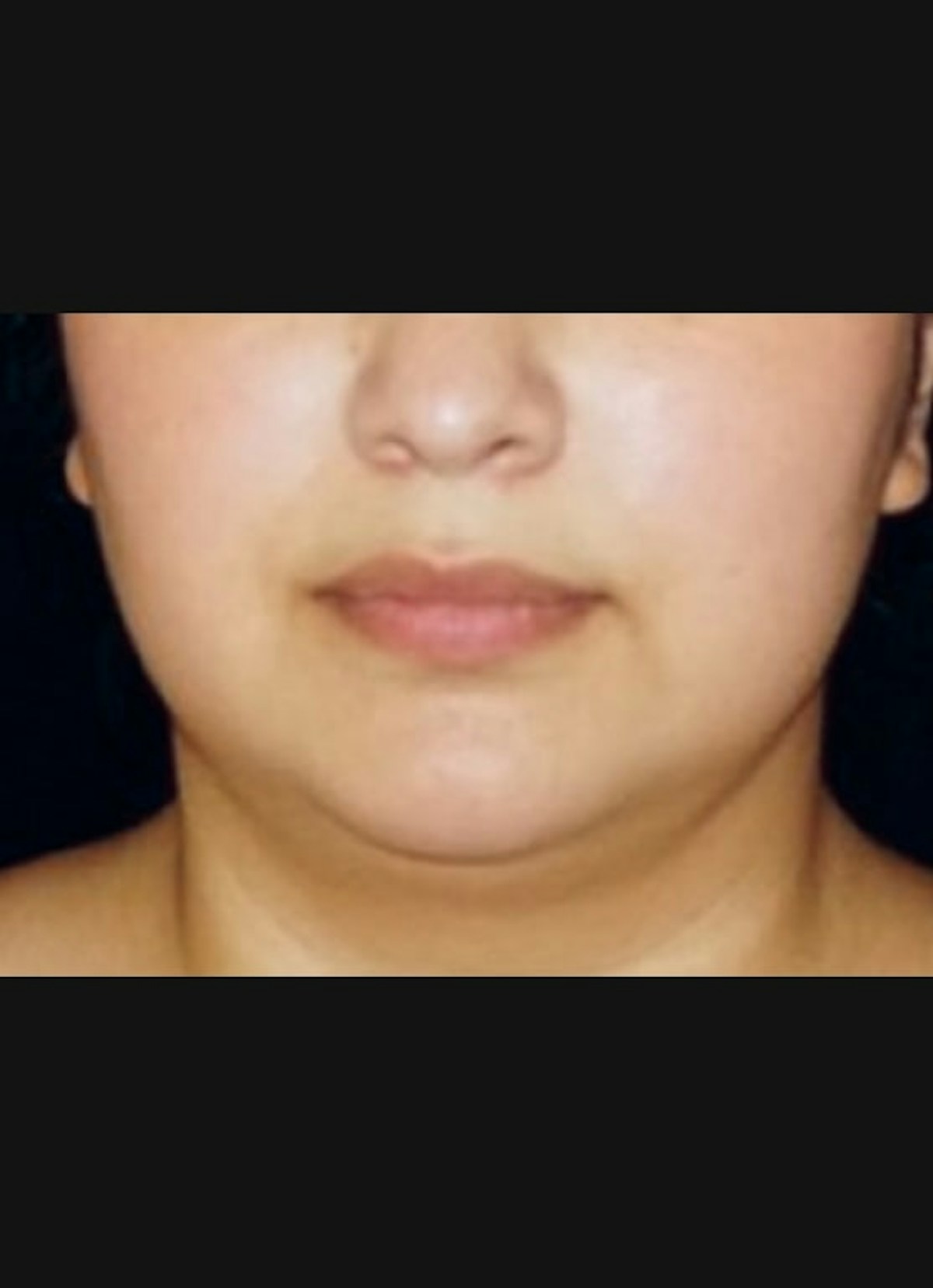 Kybella Before & After Gallery - Patient 153782 - Image 1