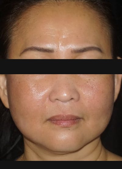 Halo Before & After Gallery - Patient 352071 - Image 2