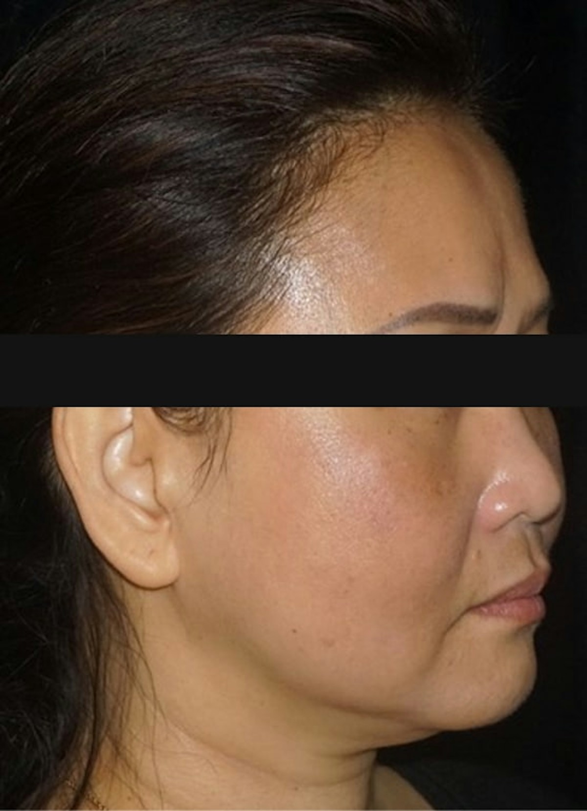 Halo Before & After Gallery - Patient 352071 - Image 4