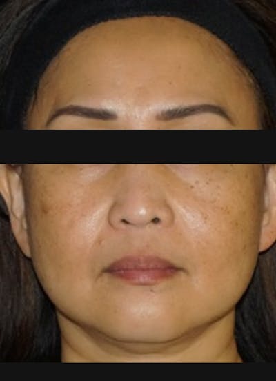 Halo Before & After Gallery - Patient 352071 - Image 1