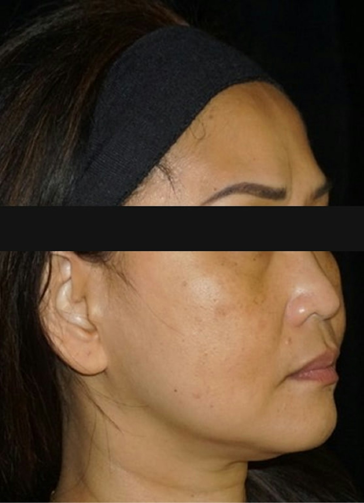 Halo Before & After Gallery - Patient 352071 - Image 3