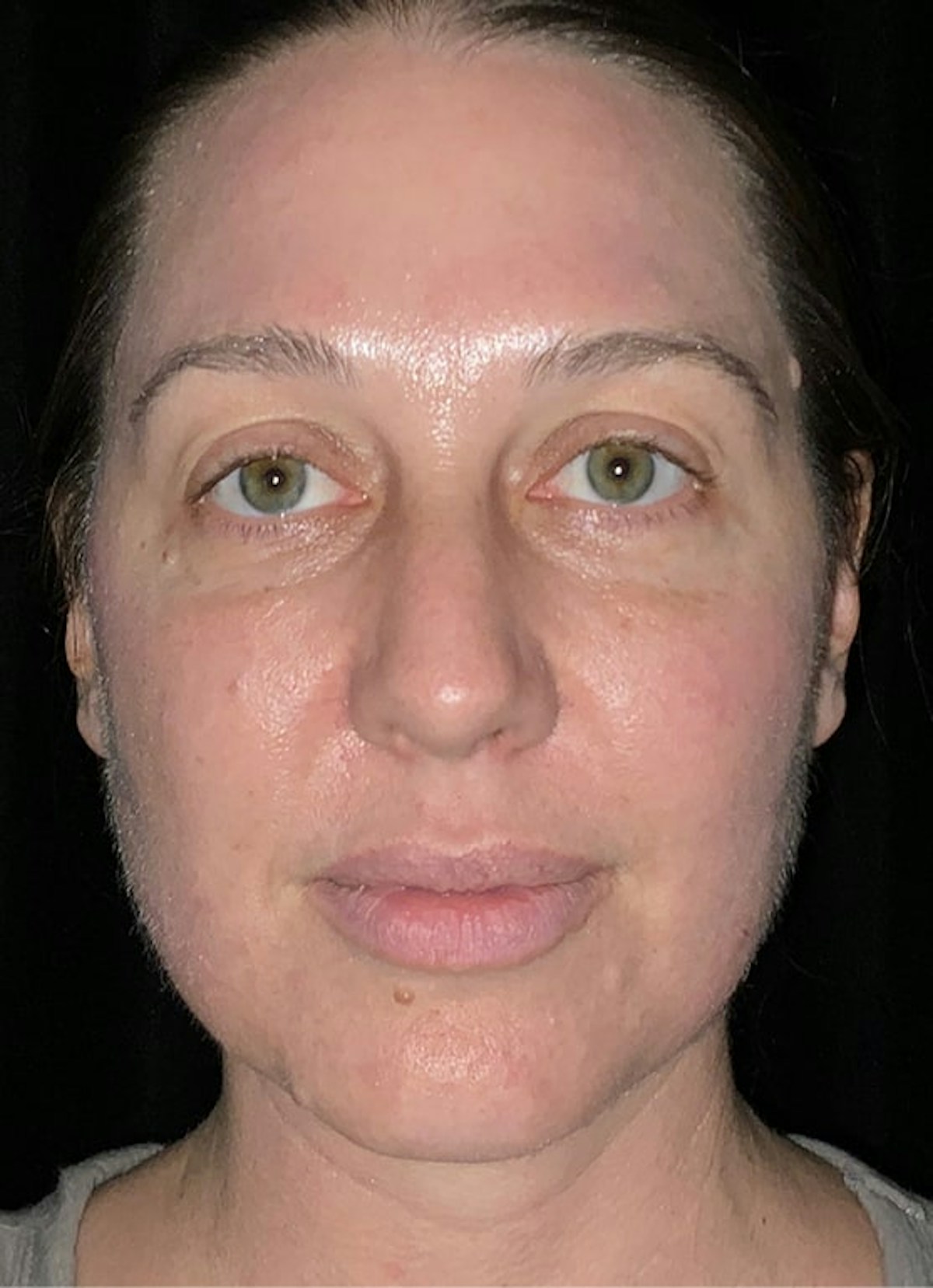 Halo Before & After Gallery - Patient 312310 - Image 2