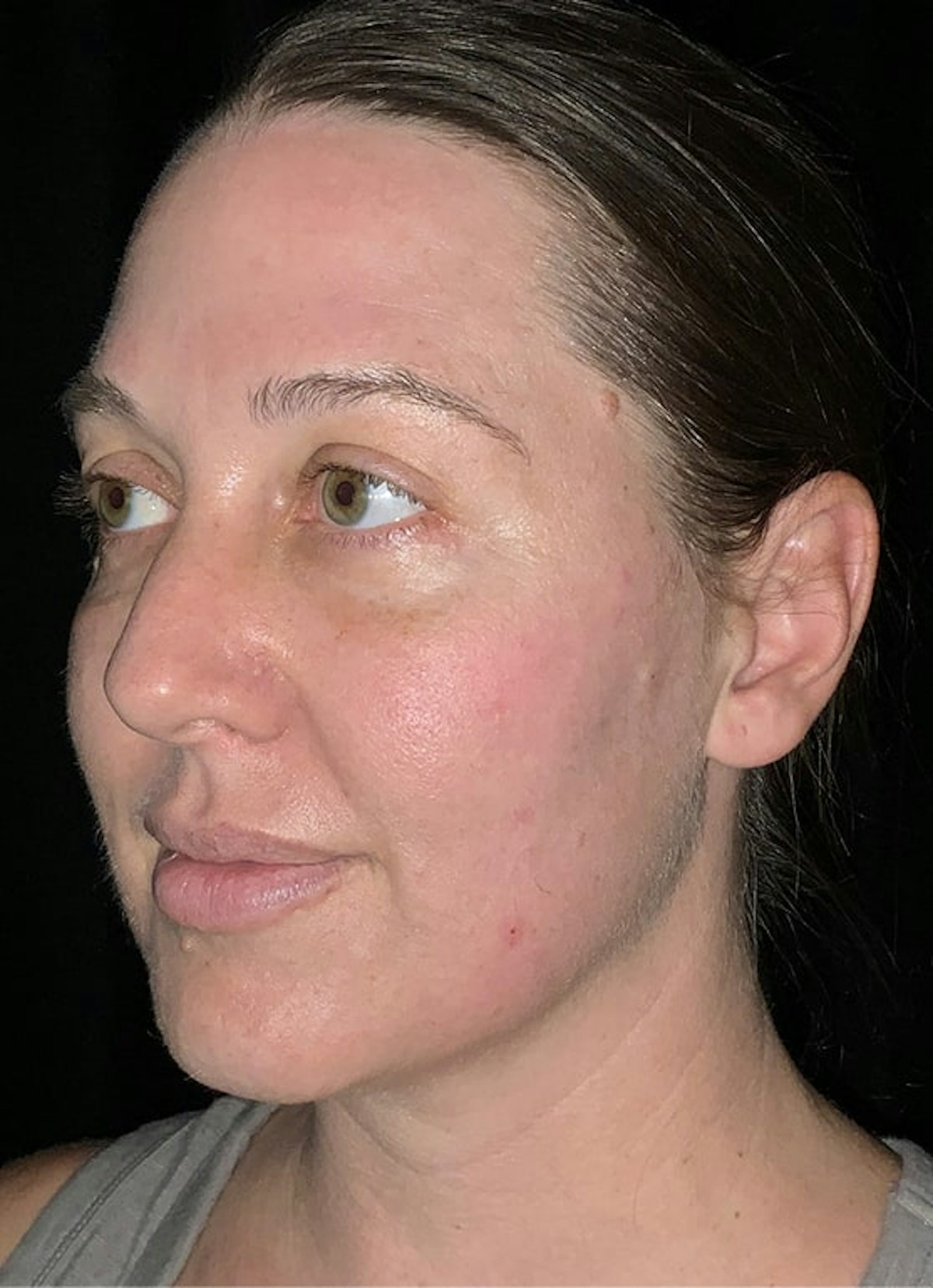 Halo Before & After Gallery - Patient 312310 - Image 4