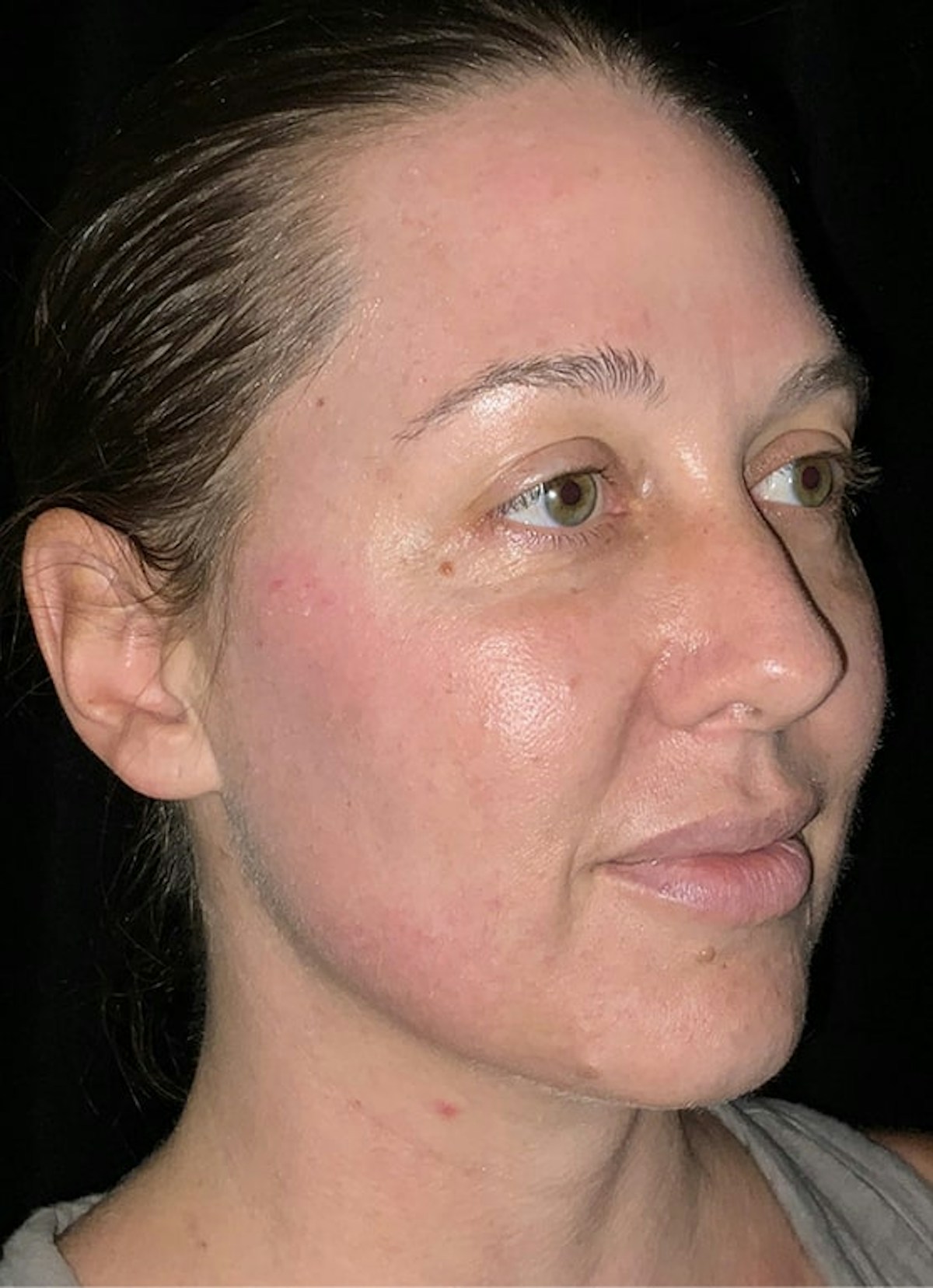 Halo Before & After Gallery - Patient 312310 - Image 6