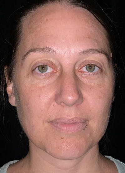 Halo Before & After Gallery - Patient 312310 - Image 1