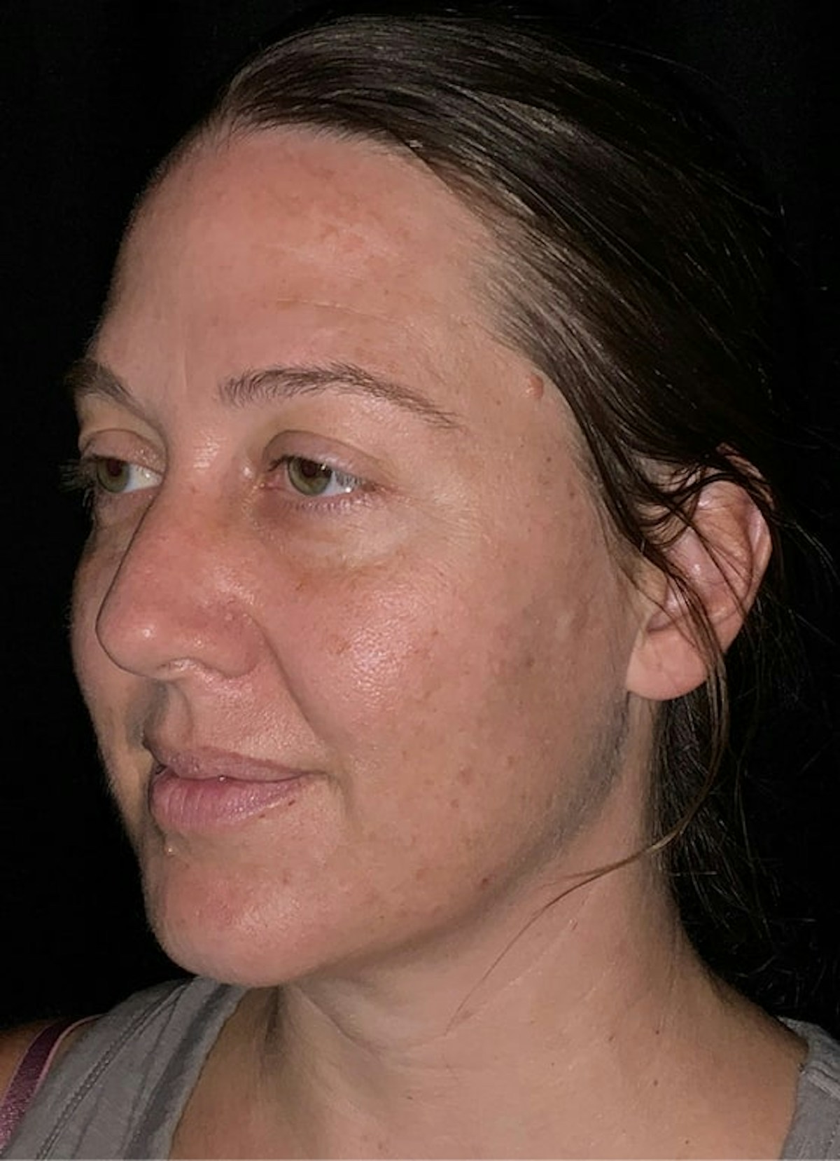 Halo Before & After Gallery - Patient 312310 - Image 3