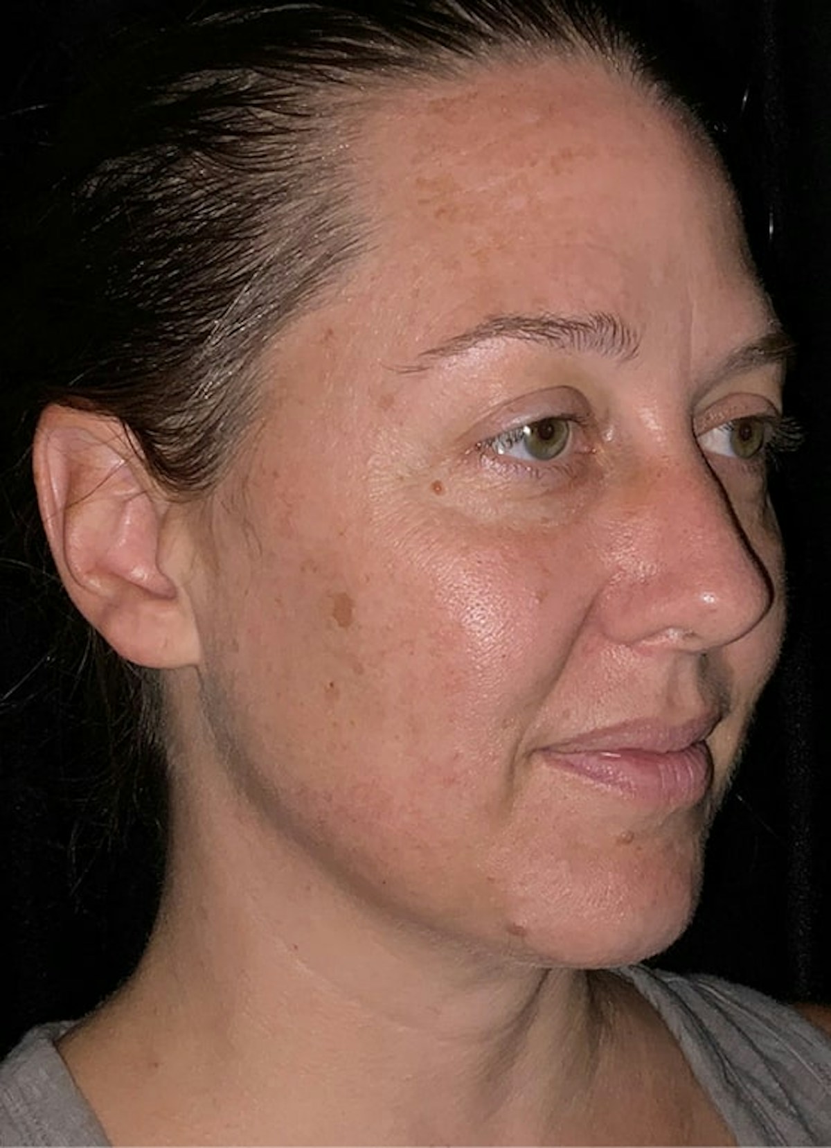 Halo Before & After Gallery - Patient 312310 - Image 5