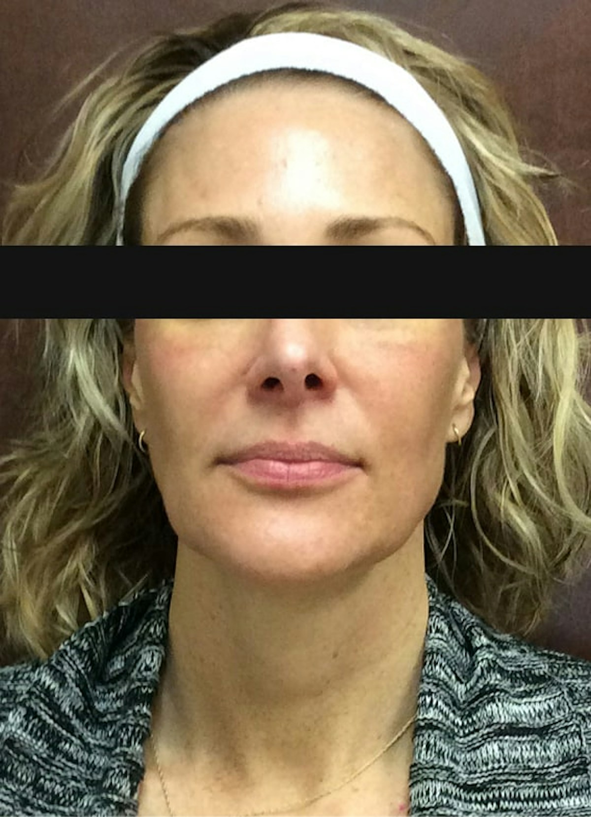 Halo Before & After Gallery - Patient 798786 - Image 2