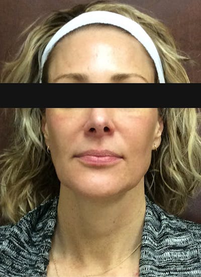 Halo Before & After Gallery - Patient 798786 - Image 2