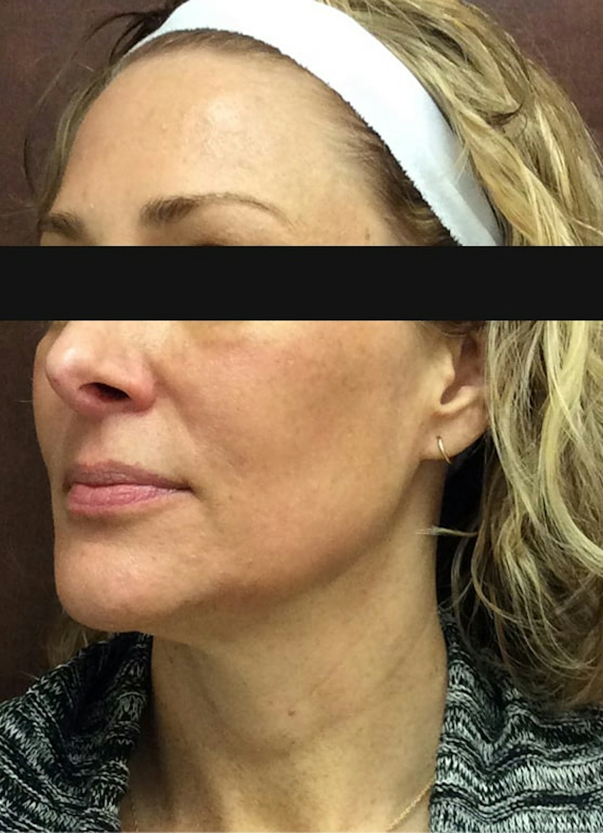 Halo Before & After Gallery - Patient 798786 - Image 4