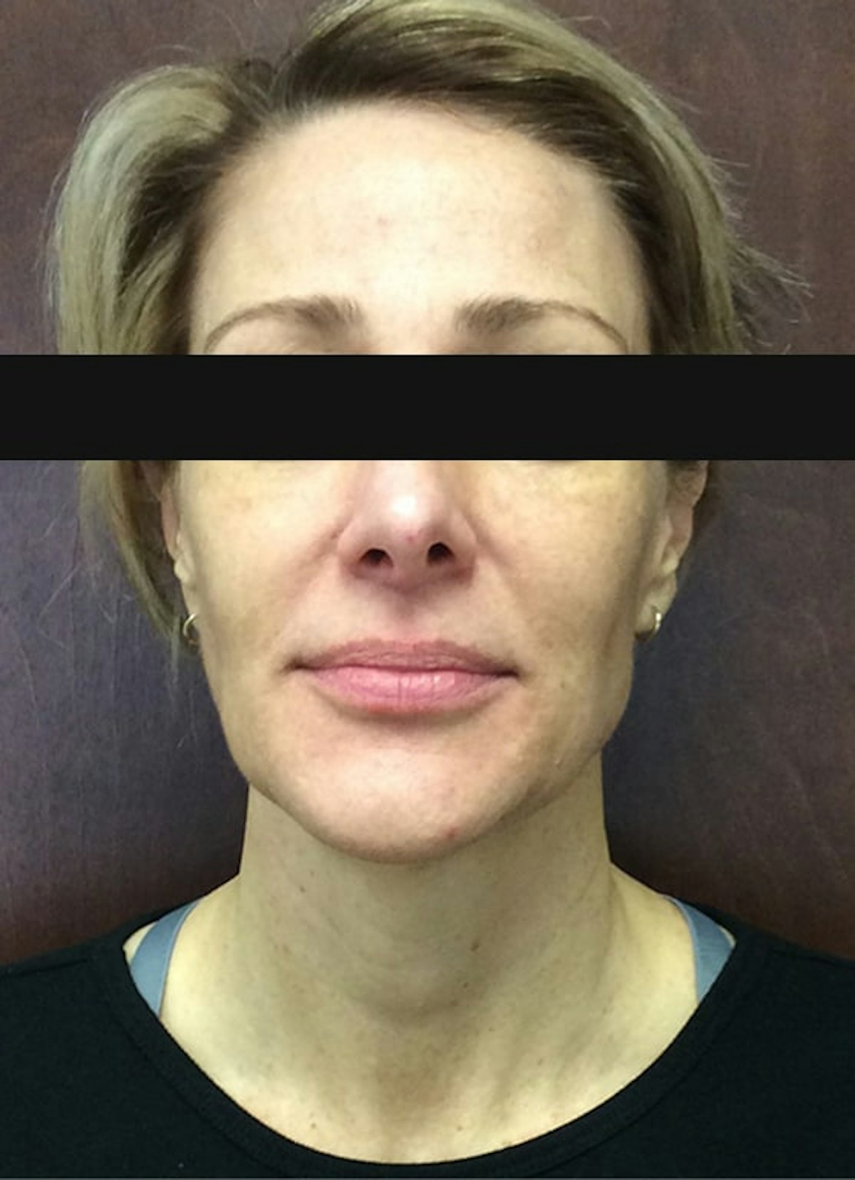 Halo Before & After Gallery - Patient 798786 - Image 1