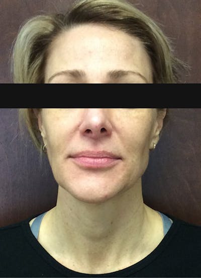 Halo Before & After Gallery - Patient 798786 - Image 1