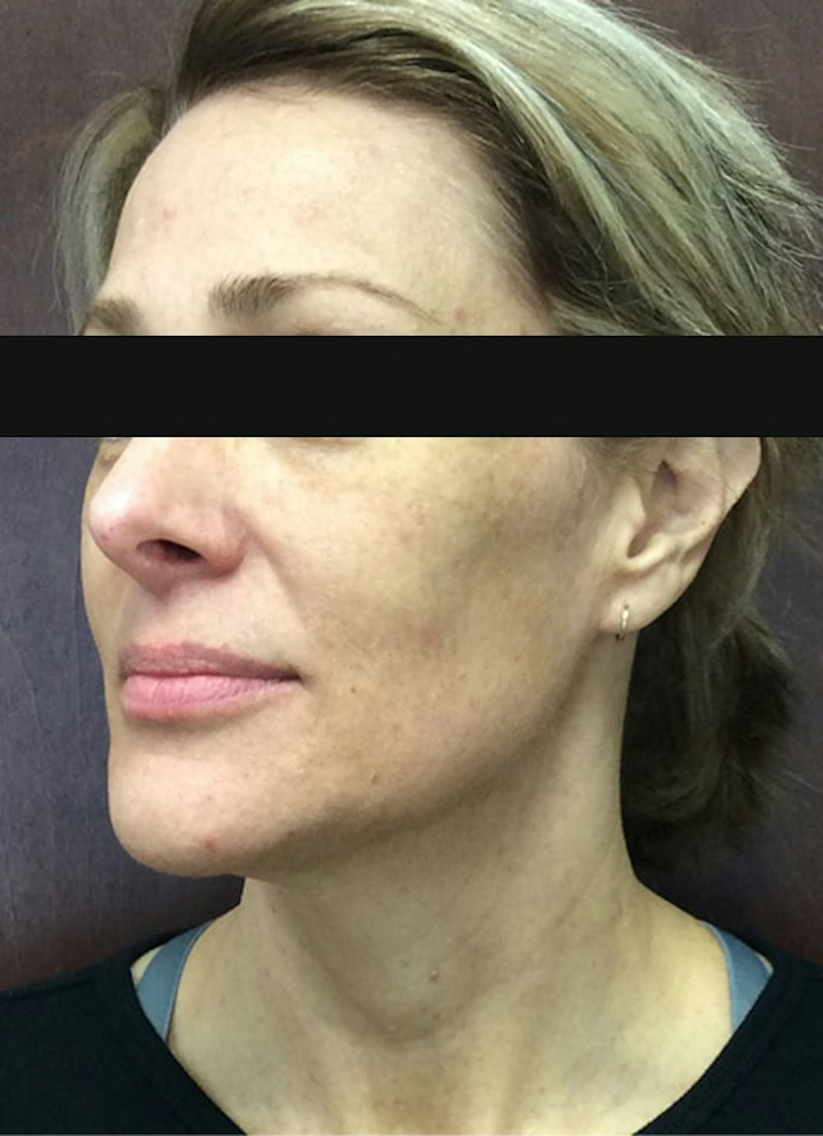 Halo Before & After Gallery - Patient 798786 - Image 3