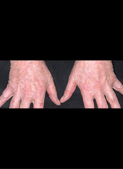 IPL Before & After Gallery - Patient 247490 - Image 2