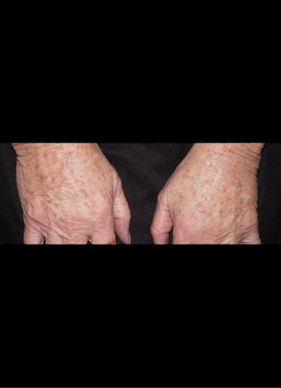 IPL Before & After Gallery - Patient 247490 - Image 1