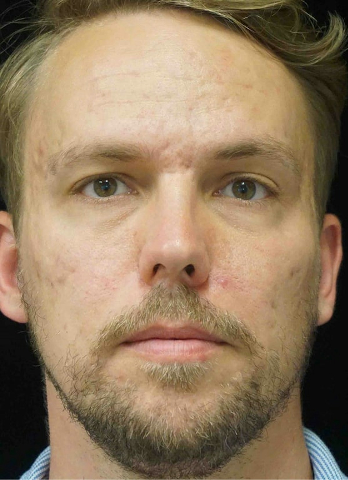 Subcision Before & After Gallery - Patient 181669 - Image 2