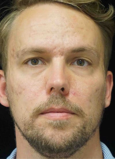 Subcision Before & After Gallery - Patient 181669 - Image 2