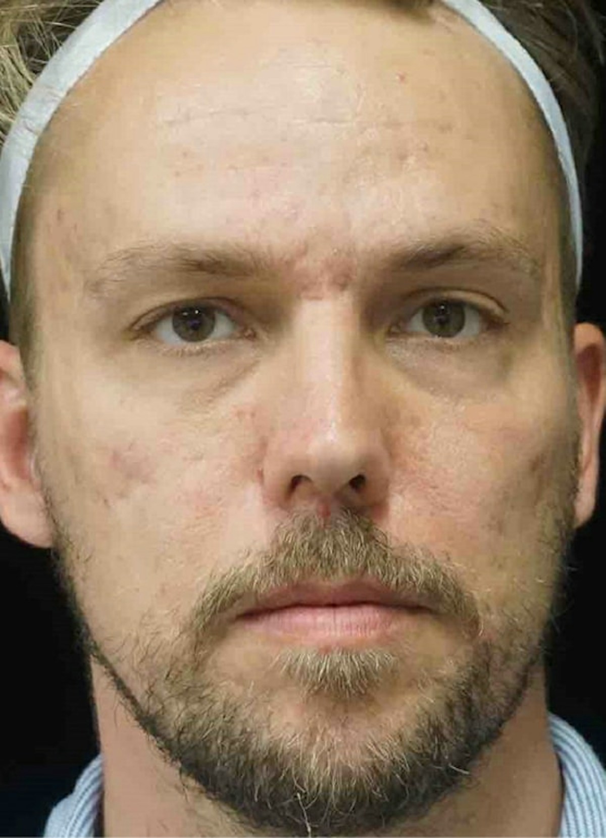 Subcision Before & After Gallery - Patient 181669 - Image 1