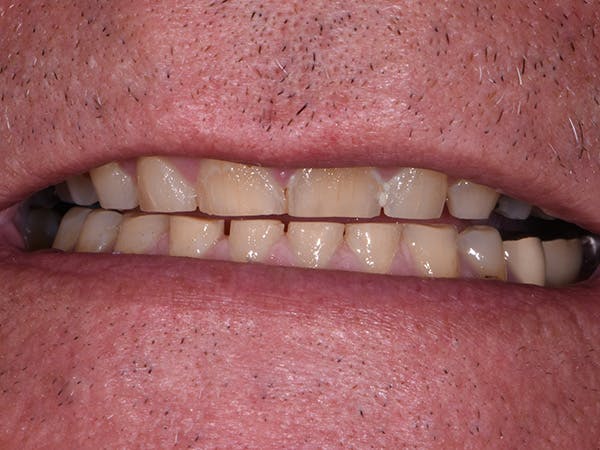 Full Mouth Restoration Before & After Gallery - Patient 167967 - Image 1